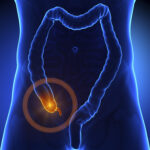 APPENDICITIS AND  SURGERY