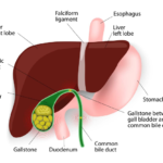 Understanding GallStones and Gallbladder Surgery: A Simplified Guide