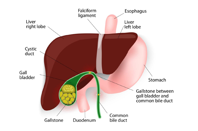 Understanding GallStones and Gallbladder Surgery: A Simplified Guide ...